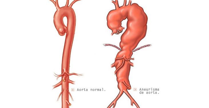 Ilustração Aneurisma de Aorta