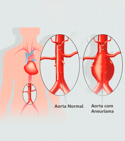 Imagem Aneurisma de Aorta