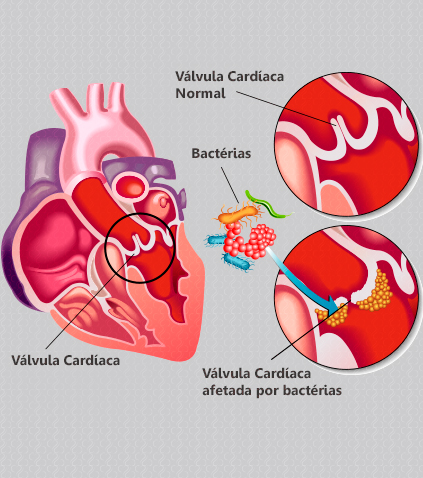 Imagem Endocardite